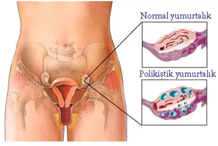 Yumurtlama Bozuklugu Tedavisi pcos