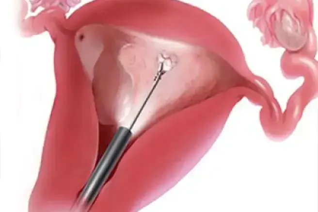 Histeroskopik Endometrial Hasarlama