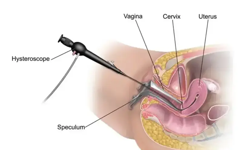 Histeroskopik Endometrial Hasarlama