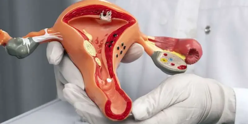 Polikistik Over Sendromu PKOS