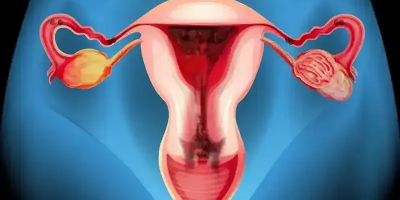 Cervical Insufficiency