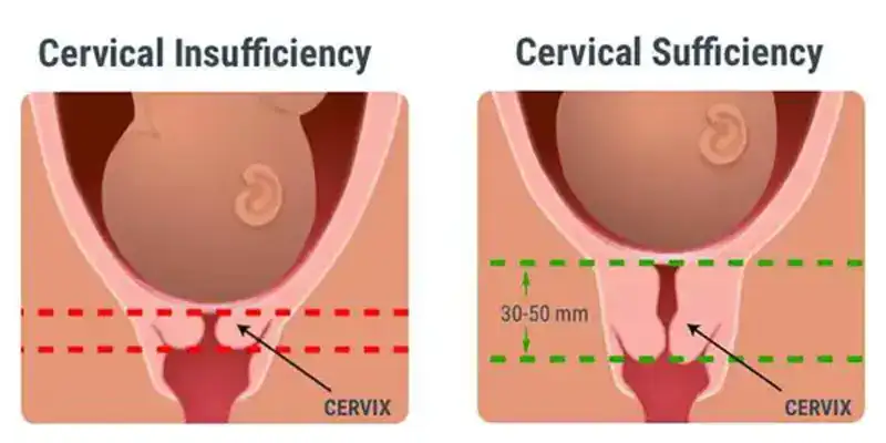 Cervical Insufficiency causes